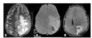 Figure from article: High-grade gliomas...