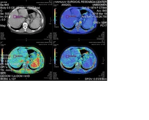 Figure from article: Portal hypertension of...