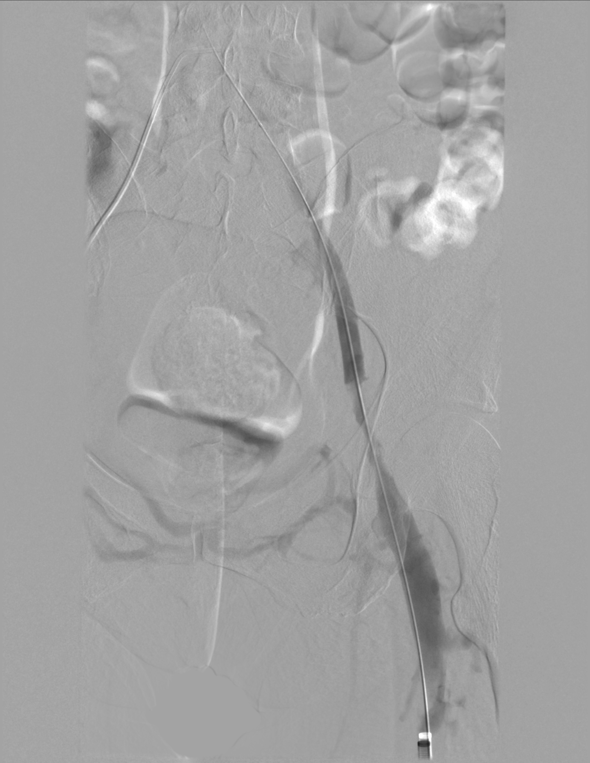 Figure from article: The DVT Recanalisation...