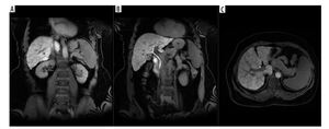 Figure from article: Fibrosis-4 and Fibrosis-5...