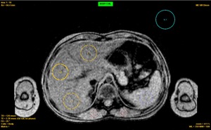 Figure from article: Quantification of liver...