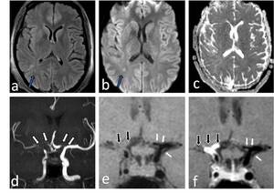 Figure from article: Magnetic resonance vessel...