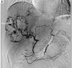 Figure from article: Transarterial...