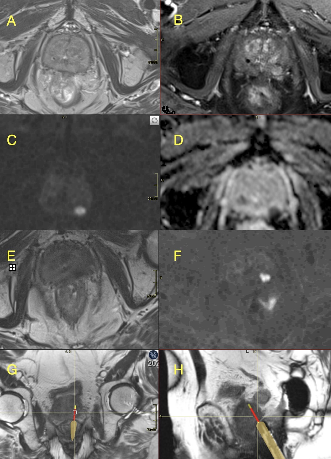 Figure from article: In-bore MRI-guided prostate...