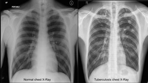 Figure from article: An automated tuberculosis...