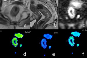 Figure from article: Intravoxel incoherent...