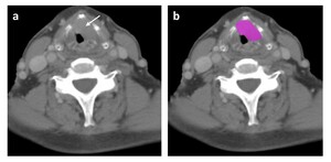 Figure from article: CT-based texture analysis...