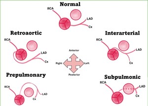Figure from article: Anomalous aortic origin...