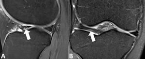 Figure from article: Anterior horn lateral...