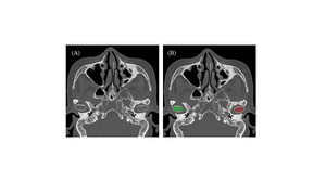 Figure from article: Quantitative CT texture...