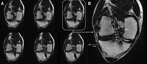Figure from article: Reliability of anterior...