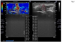 Figure from article: Shear wave elastography and...