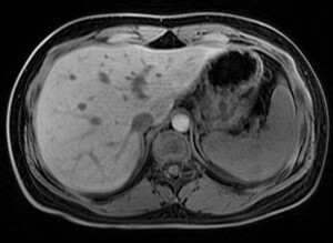 Figure from article: Association of liver...