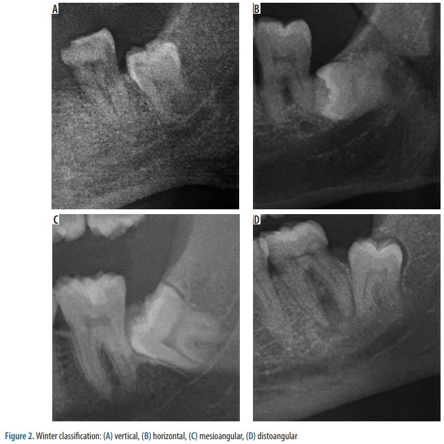 Figure from article: Assessment of impacted...